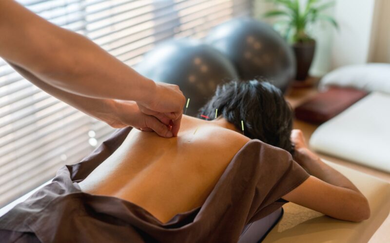 Woman getting acupuncture